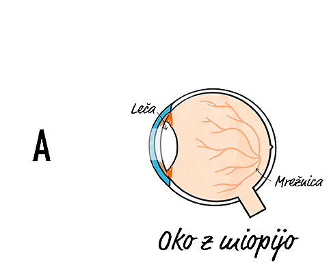 Myopic eye animation, showing light rays meeting behind the retina and a contact lens correcting vision